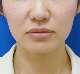 40代女性のボトックス(小顔) After 症例写真
