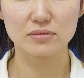 40代女性のボトックス(小顔) Before 症例写真