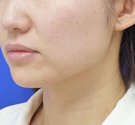 40代女性のボトックス（小顔） Before 症例写真