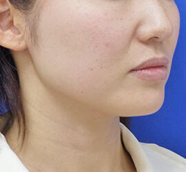 40代女性のボトックス（小顔） Before 症例写真