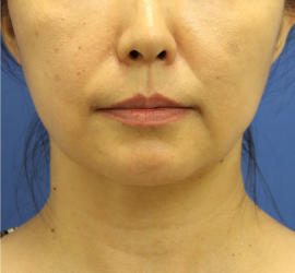 40代女性の顔の脂肪吸引 After 症例写真