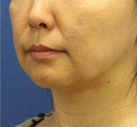 40代女性の顔の脂肪吸引  After 症例写真