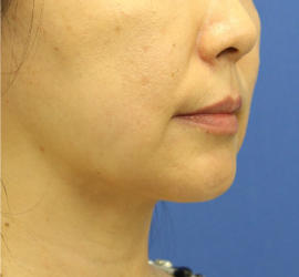 40代女性の顔の脂肪吸引  After 症例写真