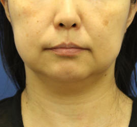 40代女性の顔の脂肪吸引 Before 症例写真