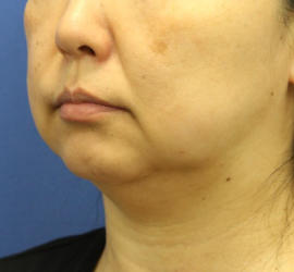 40代女性の顔の脂肪吸引  Before 症例写真