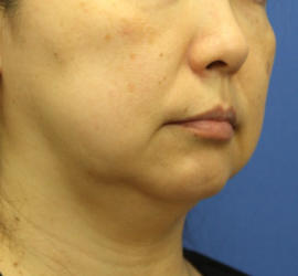 40代女性の顔の脂肪吸引  Before 症例写真