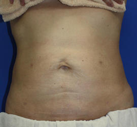 40代女性の脂肪吸引 After 症例写真