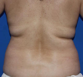 40代女性の脂肪吸引 Before 症例写真