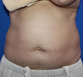 40代女性の脂肪吸引 Before 症例写真