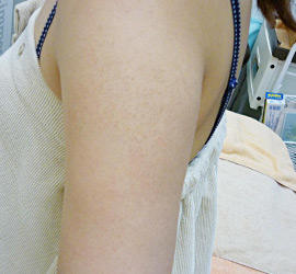 20代女性のFotonaフラクショナルレーザー(毛孔性苔癬) After 症例写真