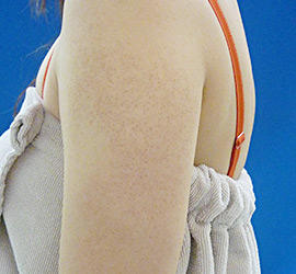 20代女性のFotonaフラクショナルレーザー(毛孔性苔癬) Before 症例写真