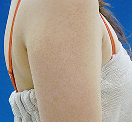 20代女性の毛孔性苔癬・角化症 Before 症例写真