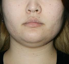 20代女性のメディカル美肌セレクト After 症例写真