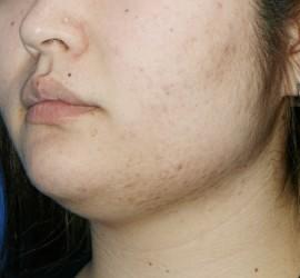 20代女性のメディカル美肌セレクト After 症例写真