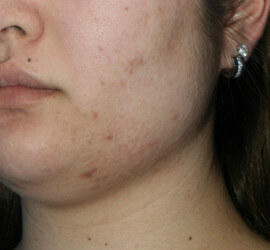 20代女性の美肌再生ピーリングコース After 症例写真