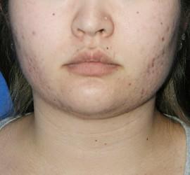 20代女性のメディカル美肌セレクト Before 症例写真