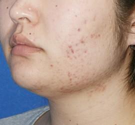 20代女性の美肌再生ピーリングコース Before 症例写真