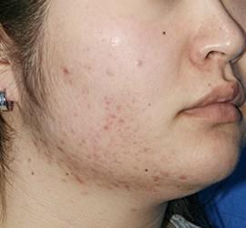 20代女性のメディカル美肌セレクト Before 症例写真