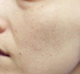 40代女性のレーザートーニング After 症例写真