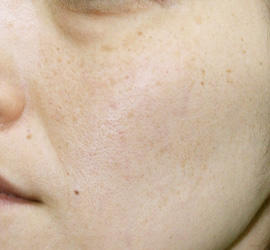 40代女性のレーザートーニング Before 症例写真