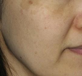 30代女性のメディカル美肌セレクト Before 症例写真