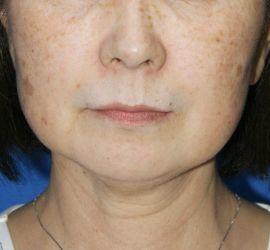 60代女性のサーマクール After 症例写真