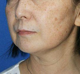 60代女性のサーマクール After 症例写真