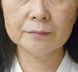 60代女性のサーマクール Before 症例写真