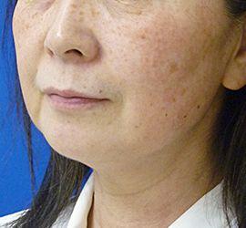 60代女性のサーマクール Before 症例写真