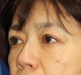 50代女性の上まぶたのたるみ取り(上眼瞼除皺術) After 症例写真