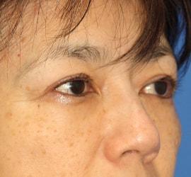 50代女性の上まぶたのたるみ取り After 症例写真