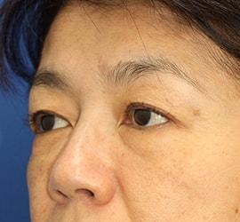 50代女性の上まぶたのたるみ取り(上眼瞼除皺術) Before 症例写真