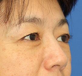 50代女性の上まぶたのたるみ取り Before 症例写真