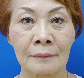 60代女性のヒアルロン酸注射  After 症例写真