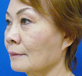 60代女性のヒアルロン酸注射  After 症例写真