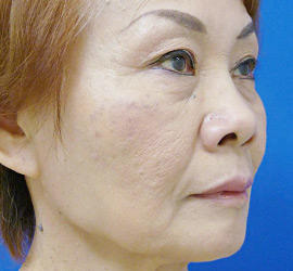 60代女性のヒアルロン酸注射  After 症例写真