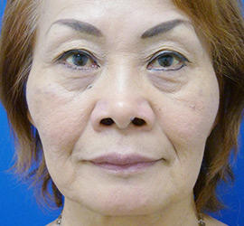 60代女性のヒアルロン酸注射  Before 症例写真