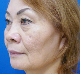 60代女性のヒアルロン酸注射  Before 症例写真