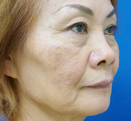 60代女性のヒアルロン酸注射  Before 症例写真