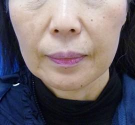 60代女性のサーマクール After 症例写真