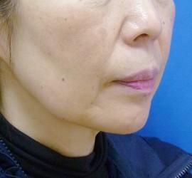 60代女性のサーマクール After 症例写真