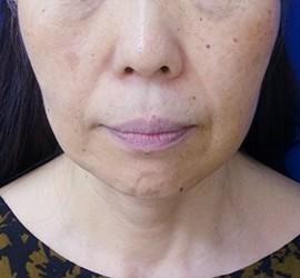 60代女性のサーマクール Before 症例写真