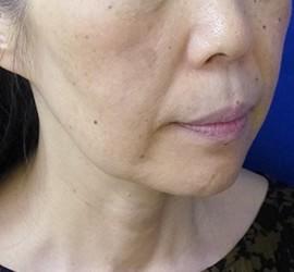60代女性のサーマクール Before 症例写真
