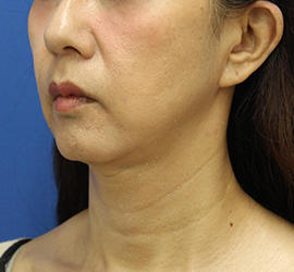 50代女性の顔の脂肪吸引  After 症例写真