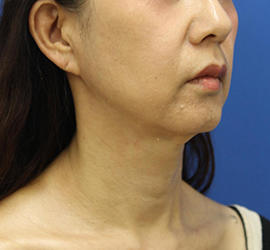 50代女性の顔の脂肪吸引 After 症例写真