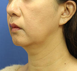 50代女性の顔の脂肪吸引  Before 症例写真