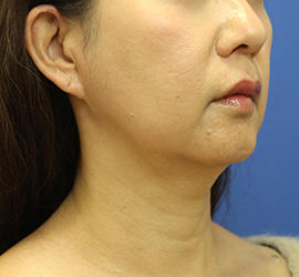 50代女性の顔の脂肪吸引 Before 症例写真