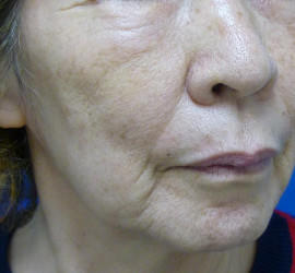 60代女性のシワ・たるみ After 症例写真