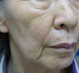 60代女性のシワ・たるみ Before 症例写真