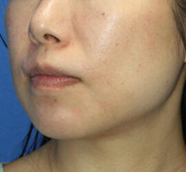 40代女性のメディカル美肌セレクト After 症例写真